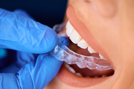 A close-up of a female patient receiving clear dental aligners.