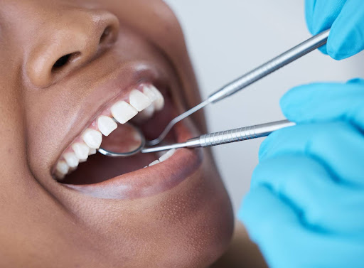 Close-up of a womans mouth during a dental checkup, with a mirror inspecting teeth for cavities