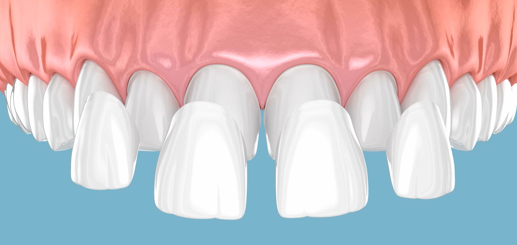 3D visual of how veneers are applied.
