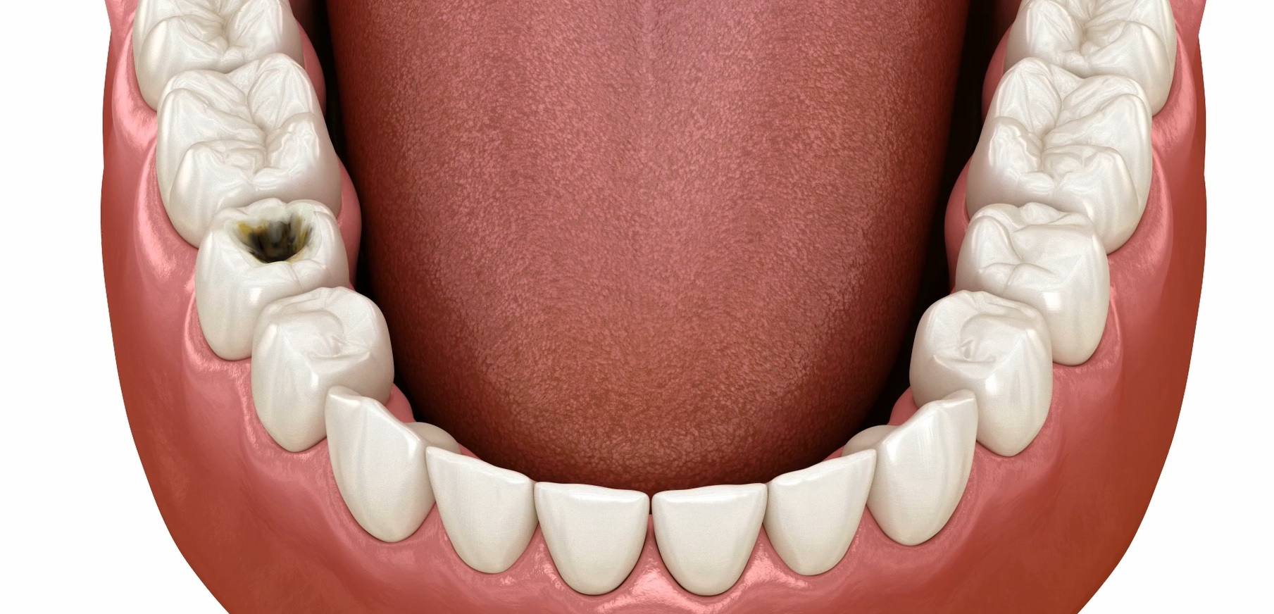 3D visual of a tooth decay.