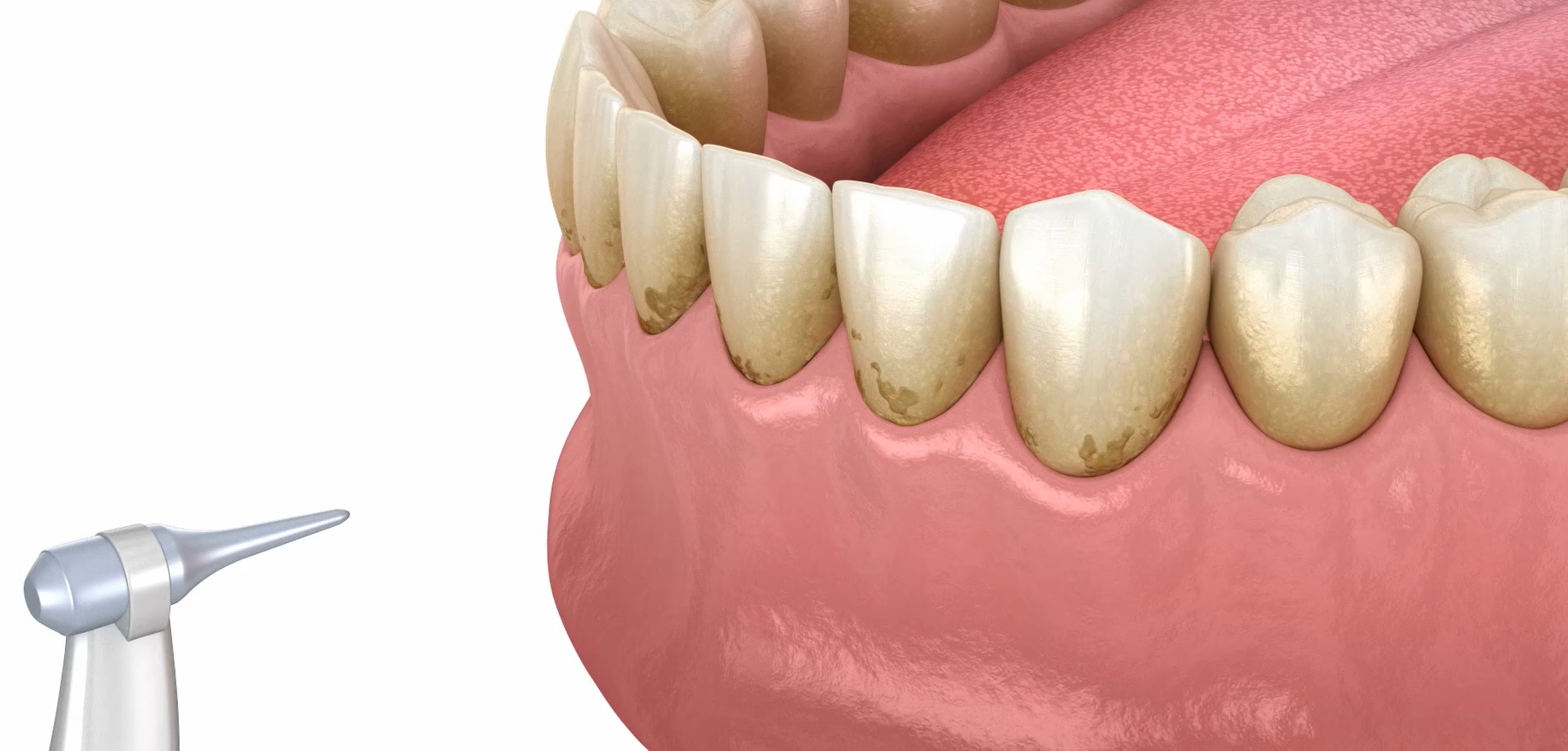 3D model of a dirty set of teeth near a cleaning tool.