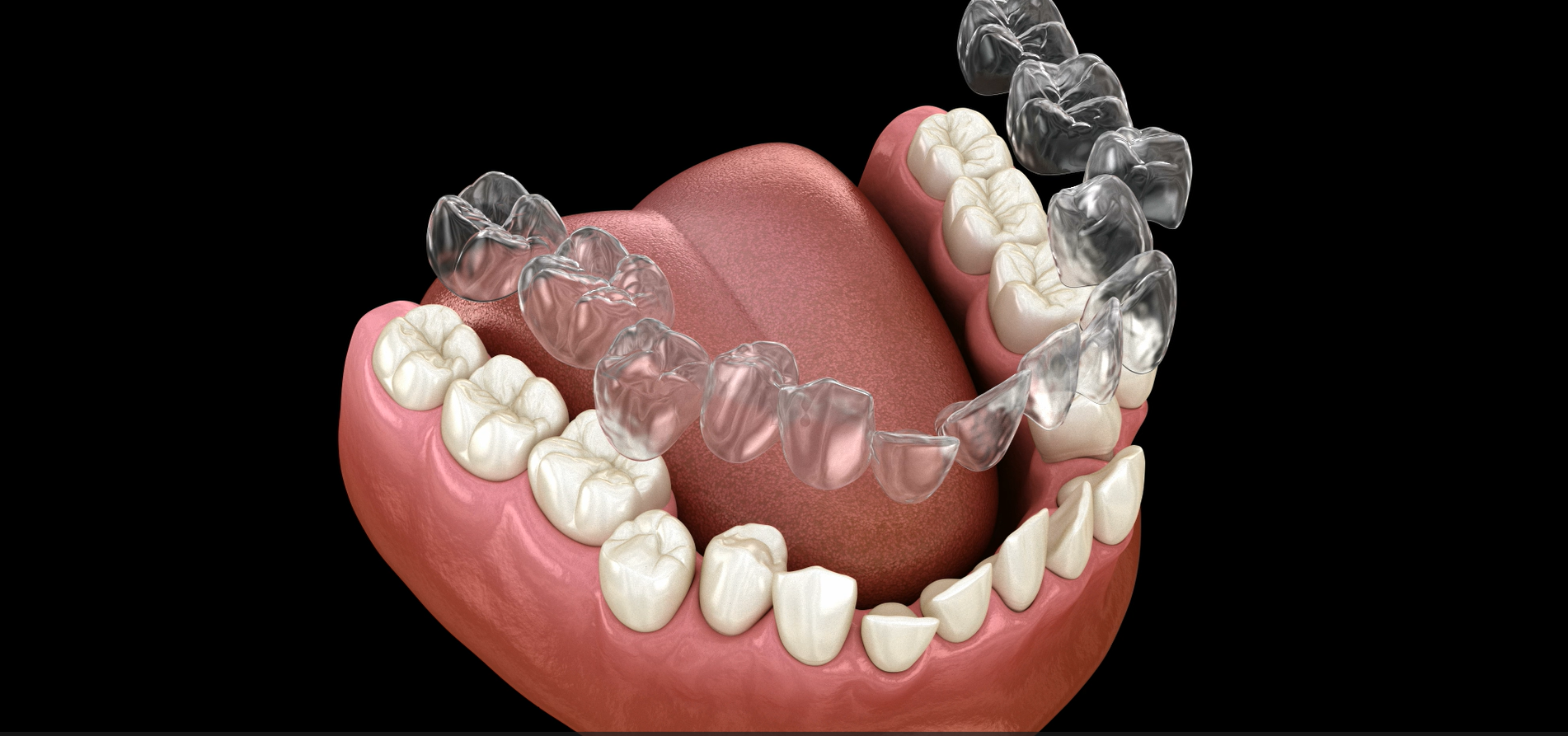 3D model of misaligned teeth.