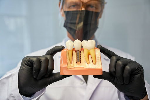 A dentist is holding up a model of a dental implant.